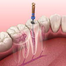 Root canal treatment illustration
