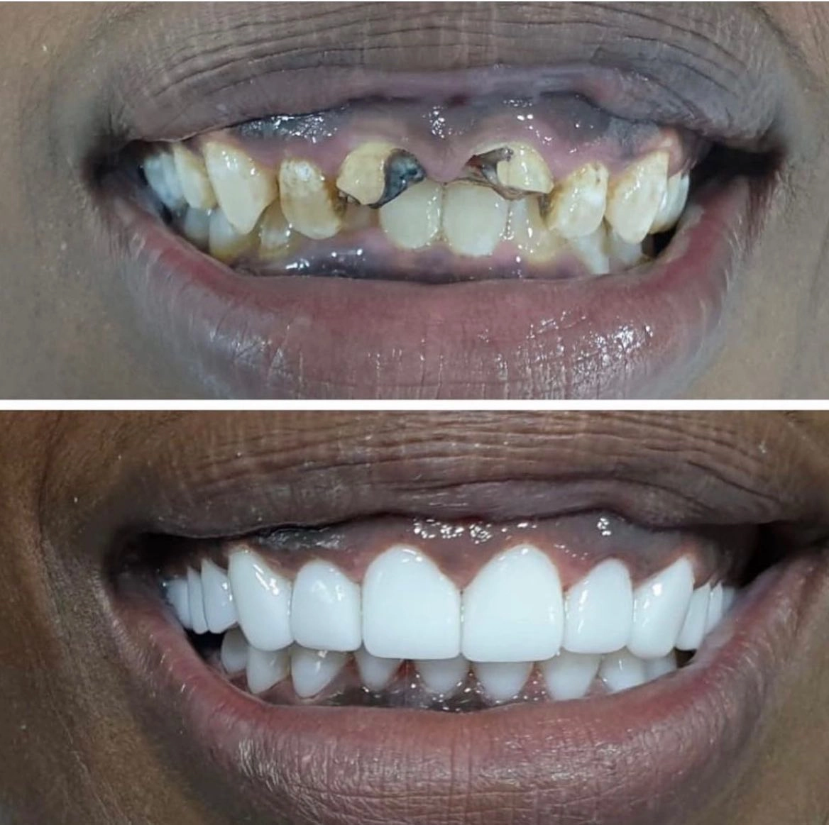 Before and after dental treatment showing dramatic smile transformation