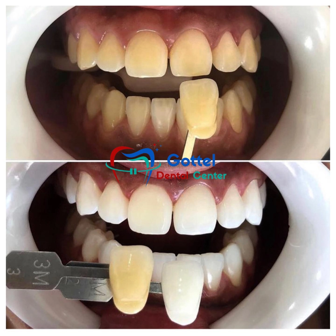 Tooth whitening treatment results